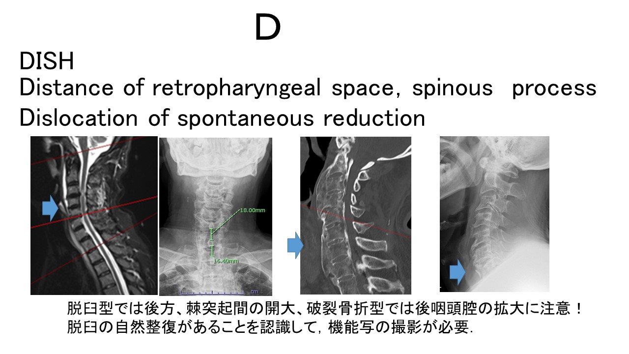 頚損Ｄ.JPG