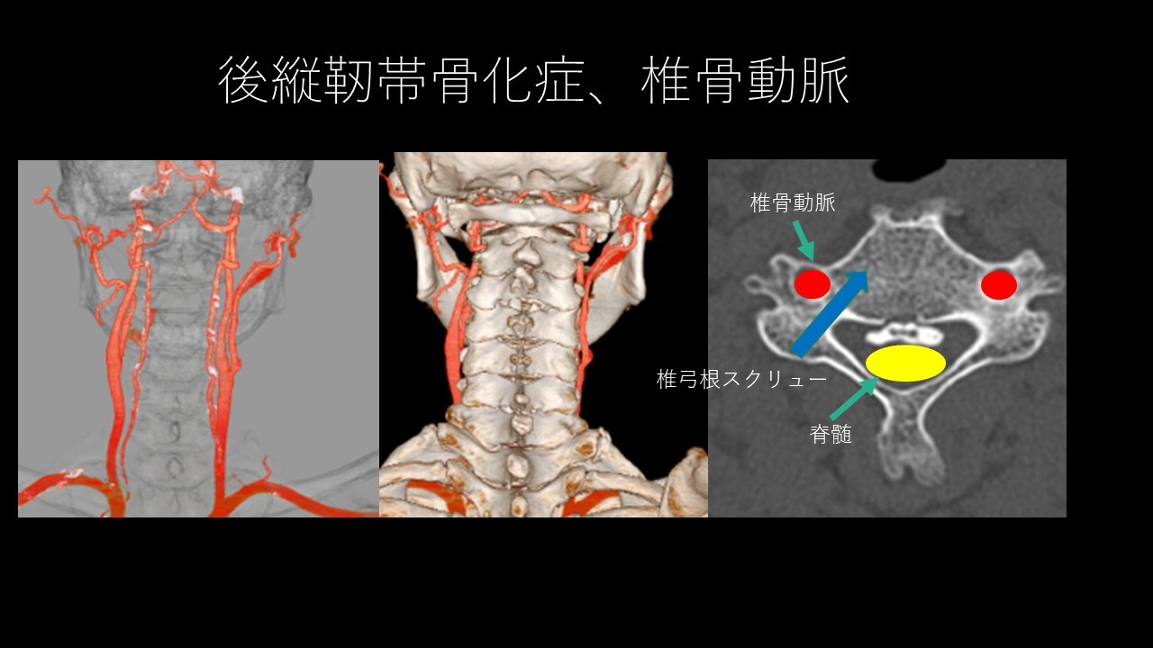 頚椎OPLLＶＡ.jpg