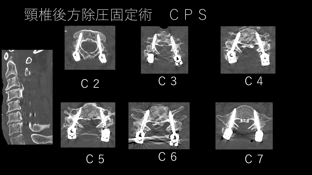 頚椎OPLLMyspine術後１.jpg