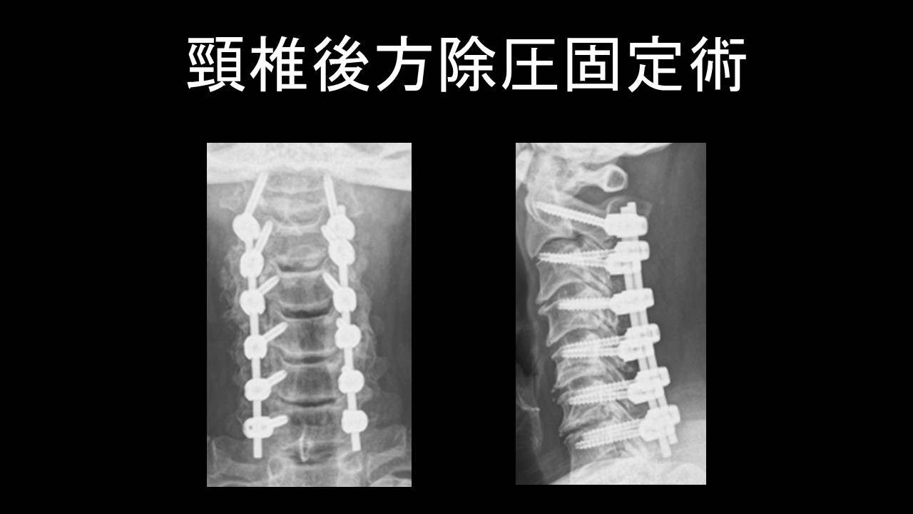 頚椎OPLLMyspine.jpg