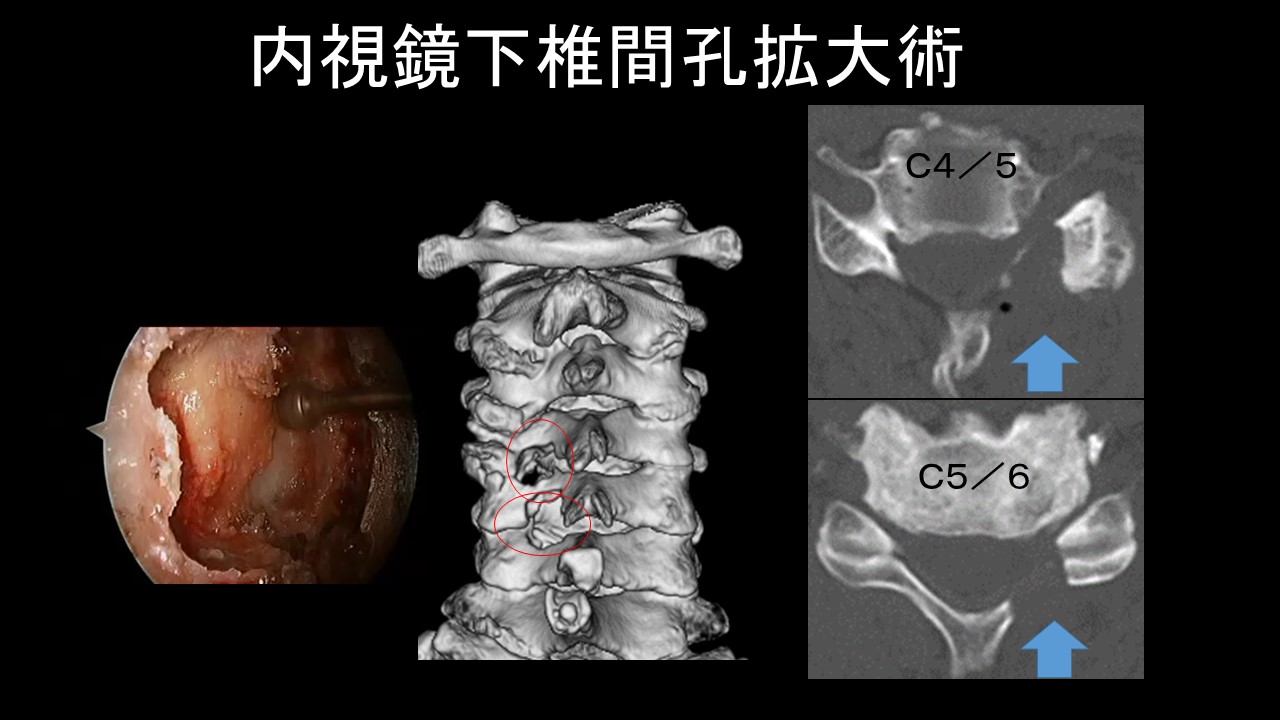 頸椎内視鏡視下椎間孔拡大術.jpg