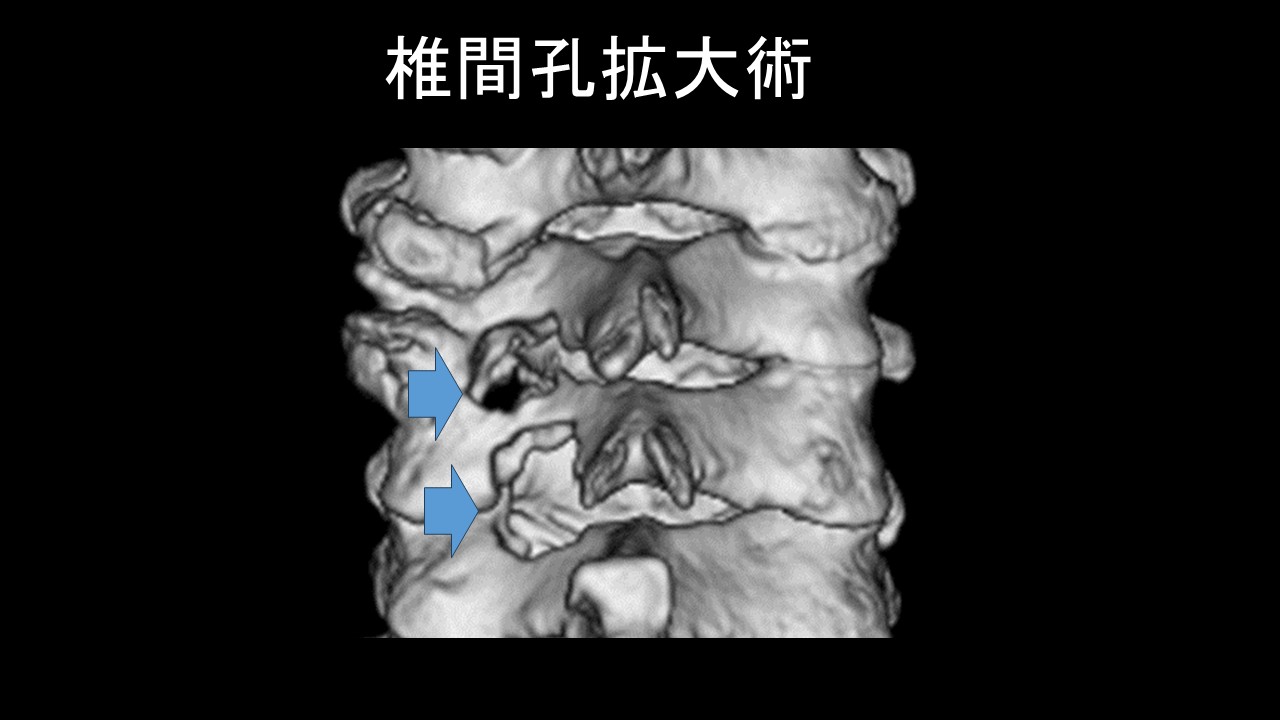 頸椎間孔拡大術.jpg