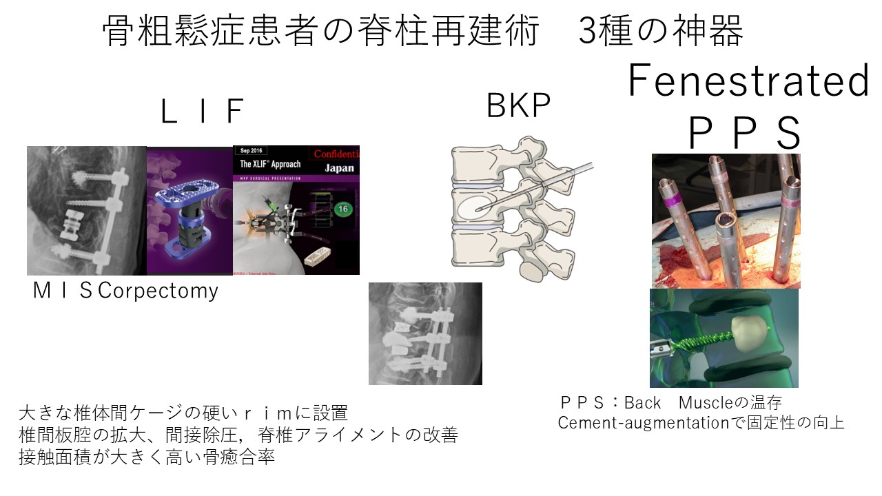 骨粗しょう症3種の神器.JPG