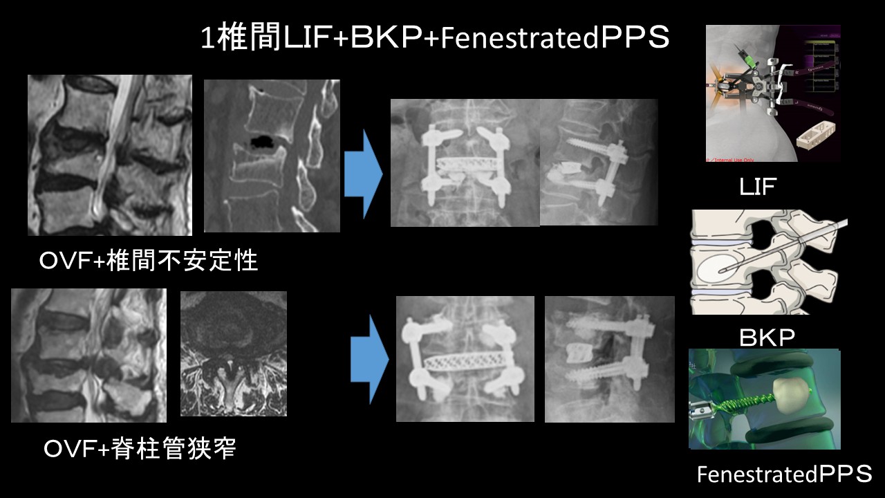 １椎間ＬＩＦ.JPG