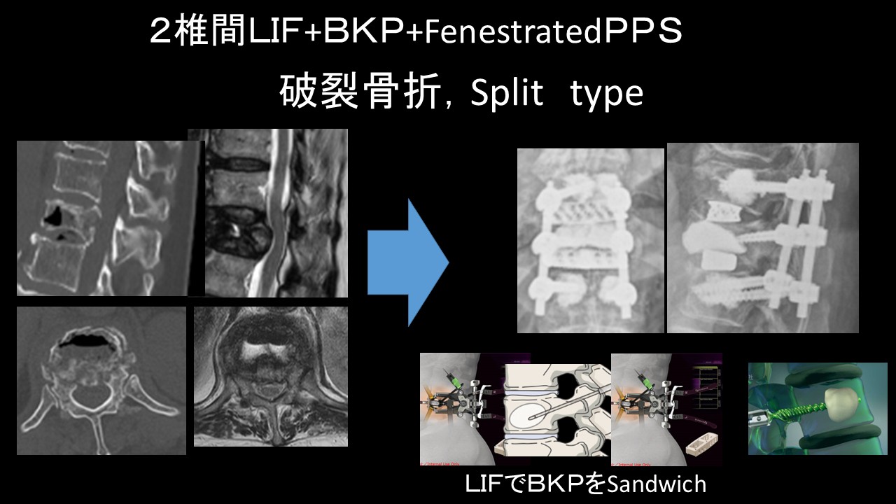 ２椎間ＬＩＦ.JPG