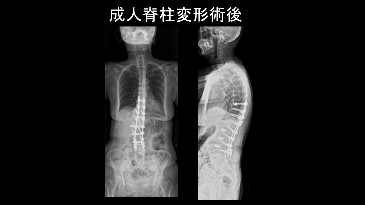 ＡＳＤ術後.jpg
