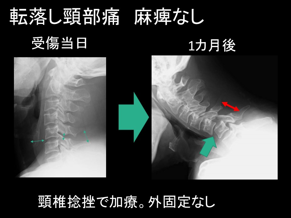 ＤＦ脱臼.jpg