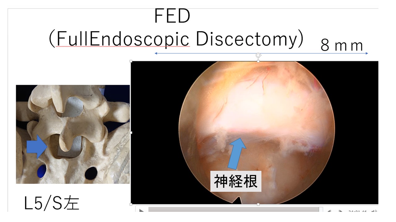 ＦＥＤ内視鏡画像.JPG