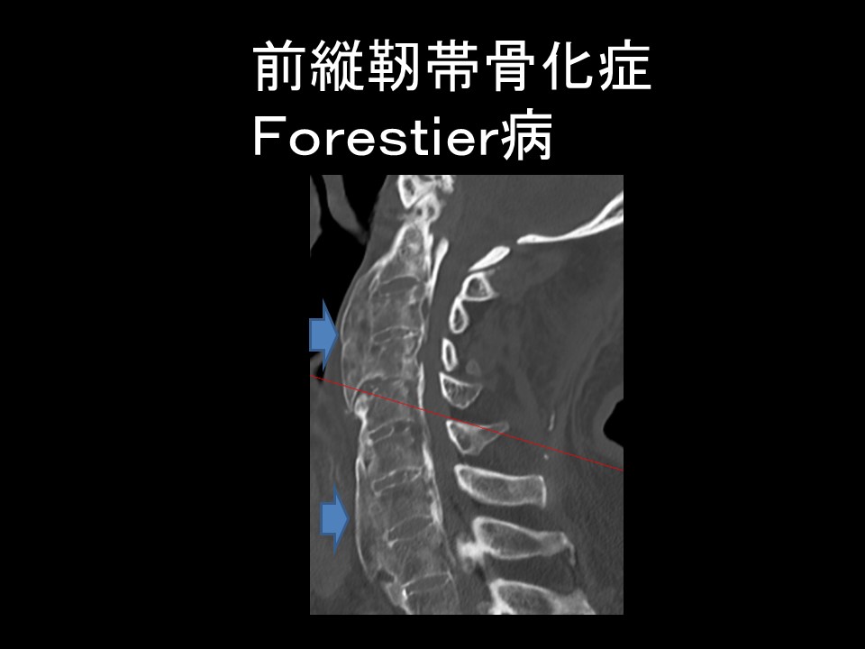 Ｆｏｒｅｓｔｉｅｒ病.jpg