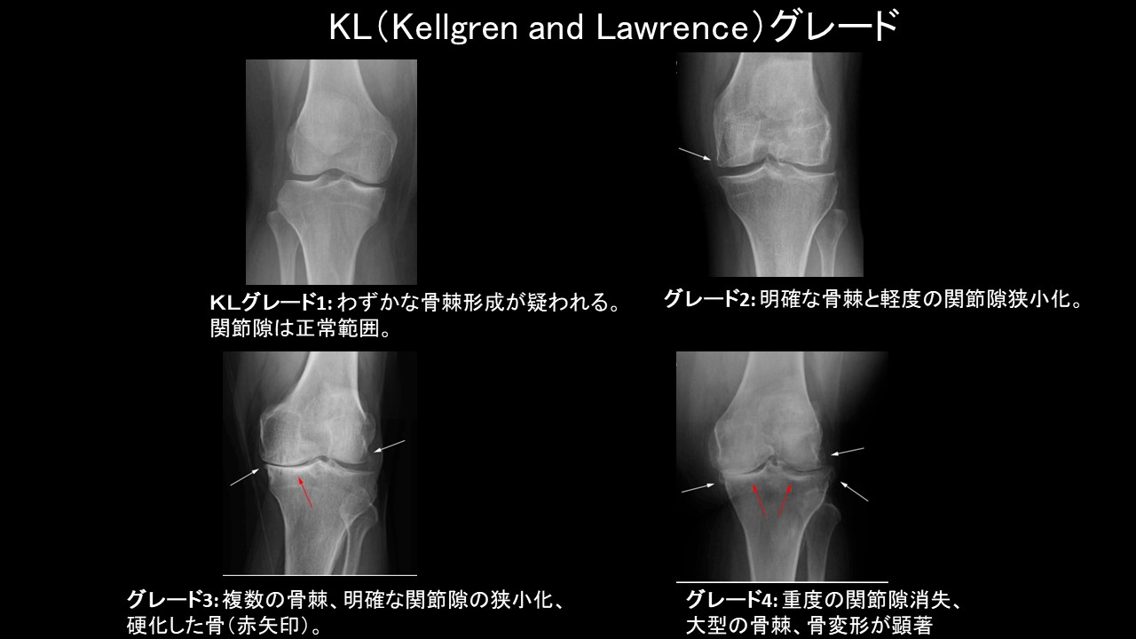 ＫＬ分類.JPG