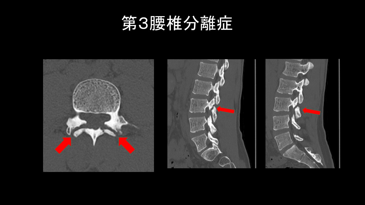 Ｌ３分離ＣＴ.JPG