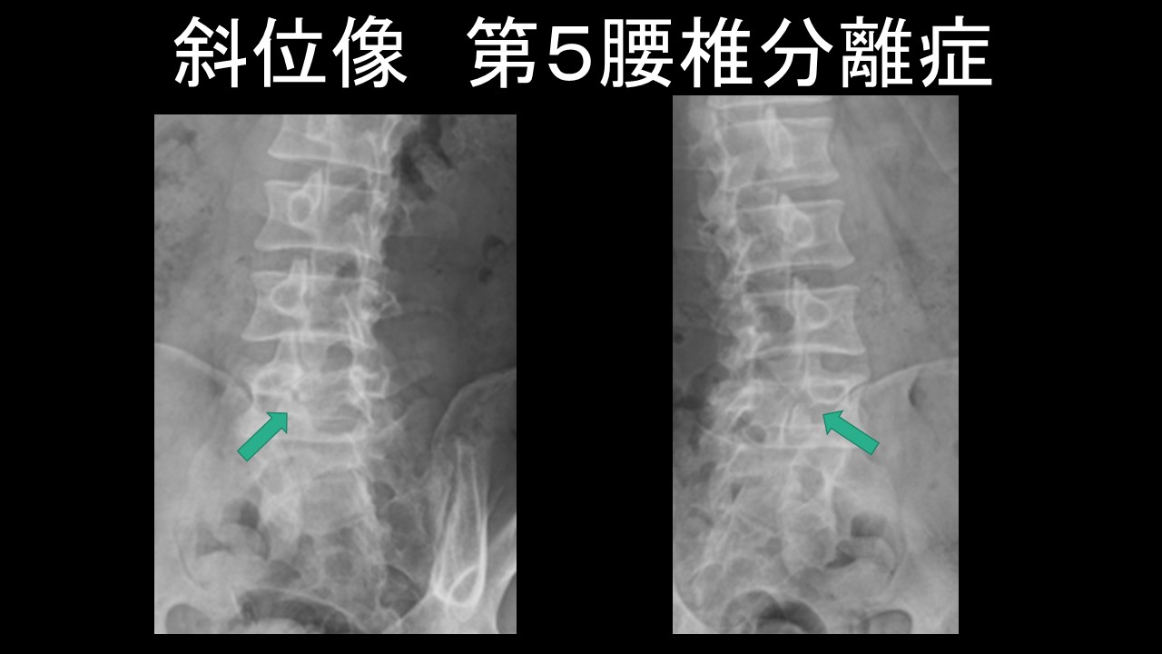 Ｌ５分離斜位像.JPG