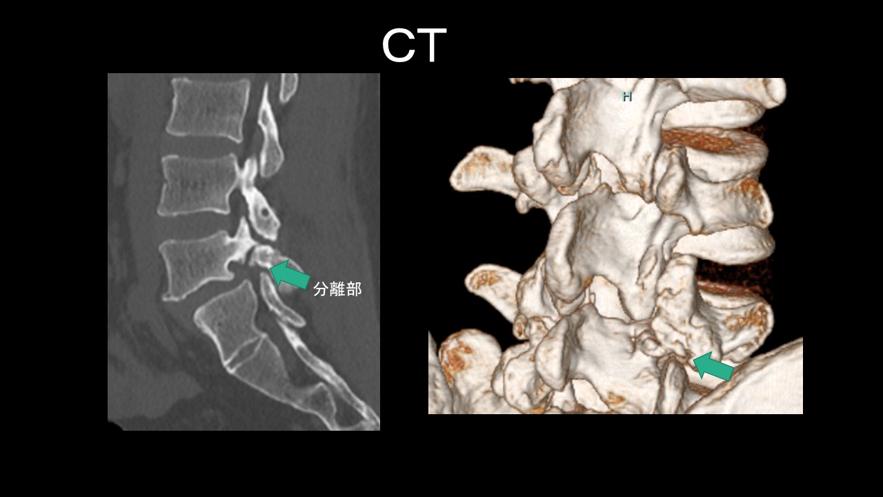 Ｌ５分離ＣＴ.JPG