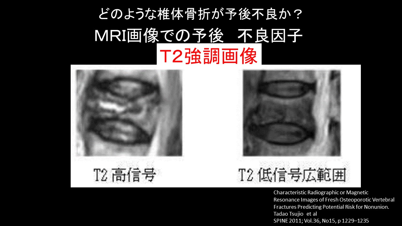 ＭＲＩ予後不良因子.JPG