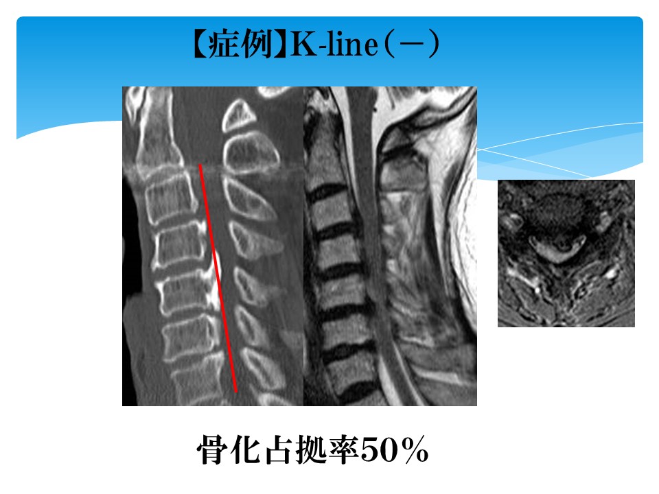 ＯＰＬＬK-Lineマイナス症例.jpg