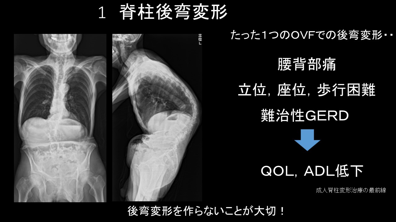 ＯＶＦ後弯変形.jpg