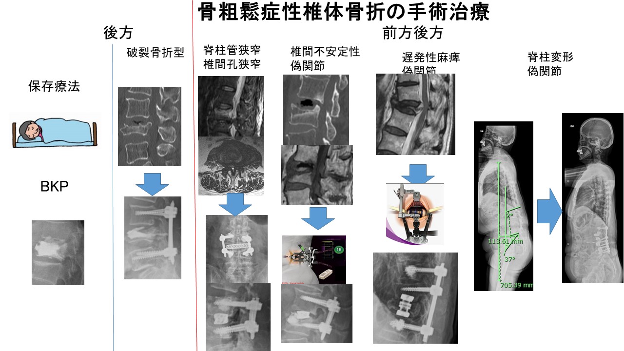 ＯＶＦ手術種類.JPG