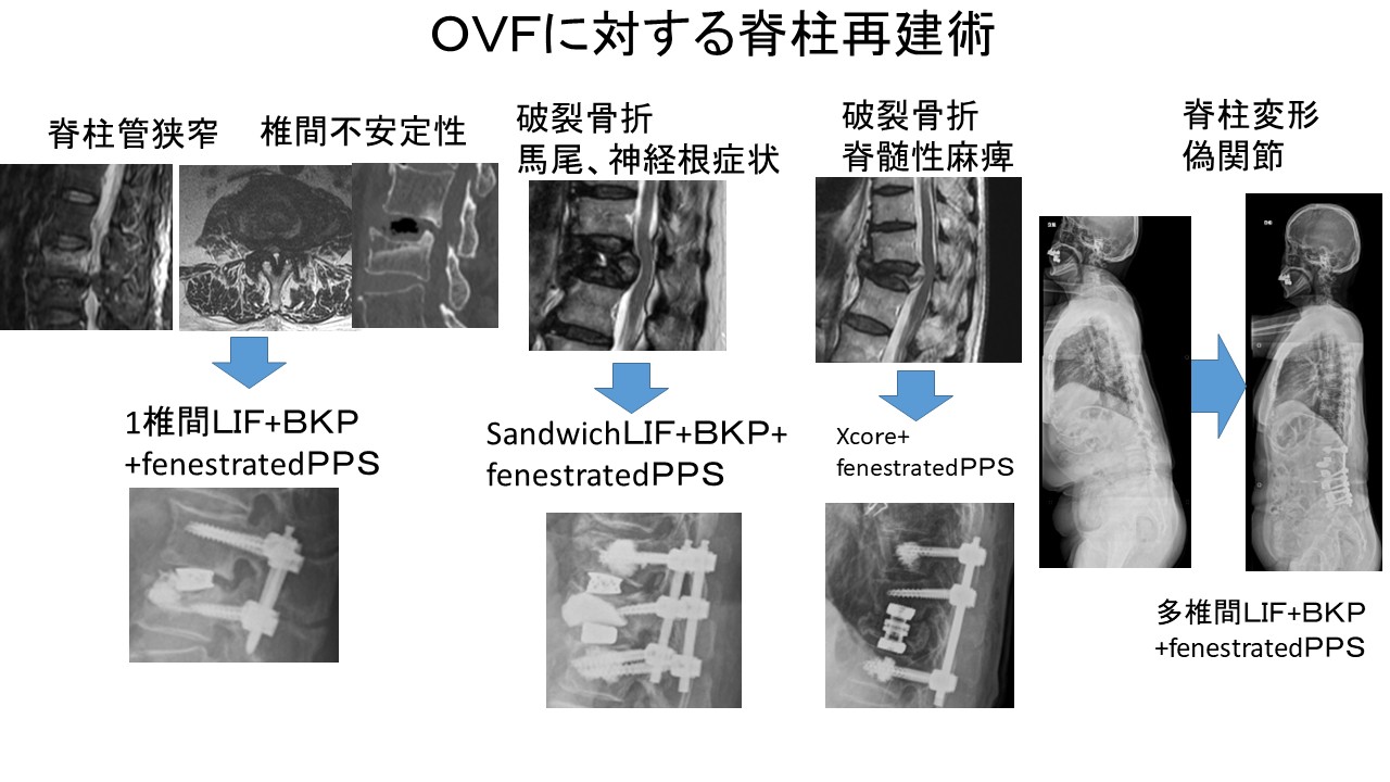 ＯＶＦ脊柱再建術.JPG