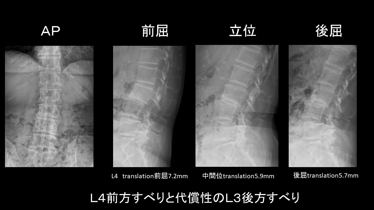 ＰＥＴＬＩＦ症例２.JPG