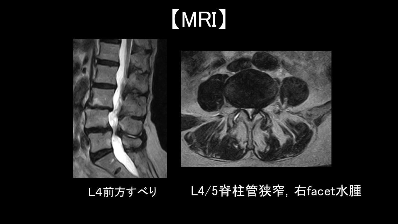 ＰＥＴＬＩＦ症例３.JPG