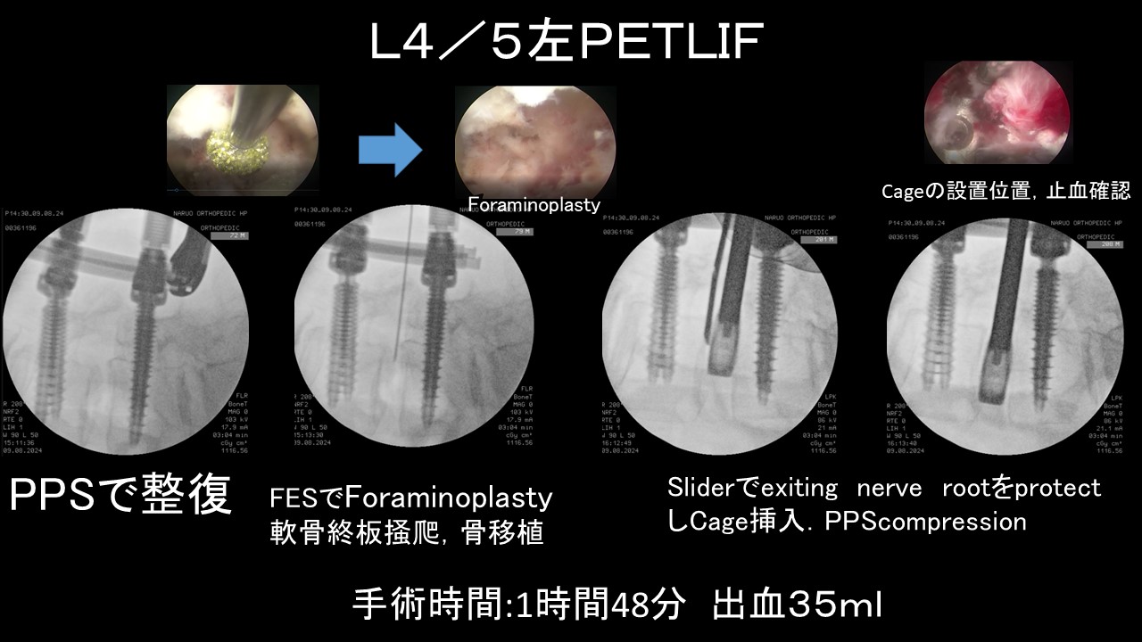 ＰＥＴＬＩＦ症例４.JPG