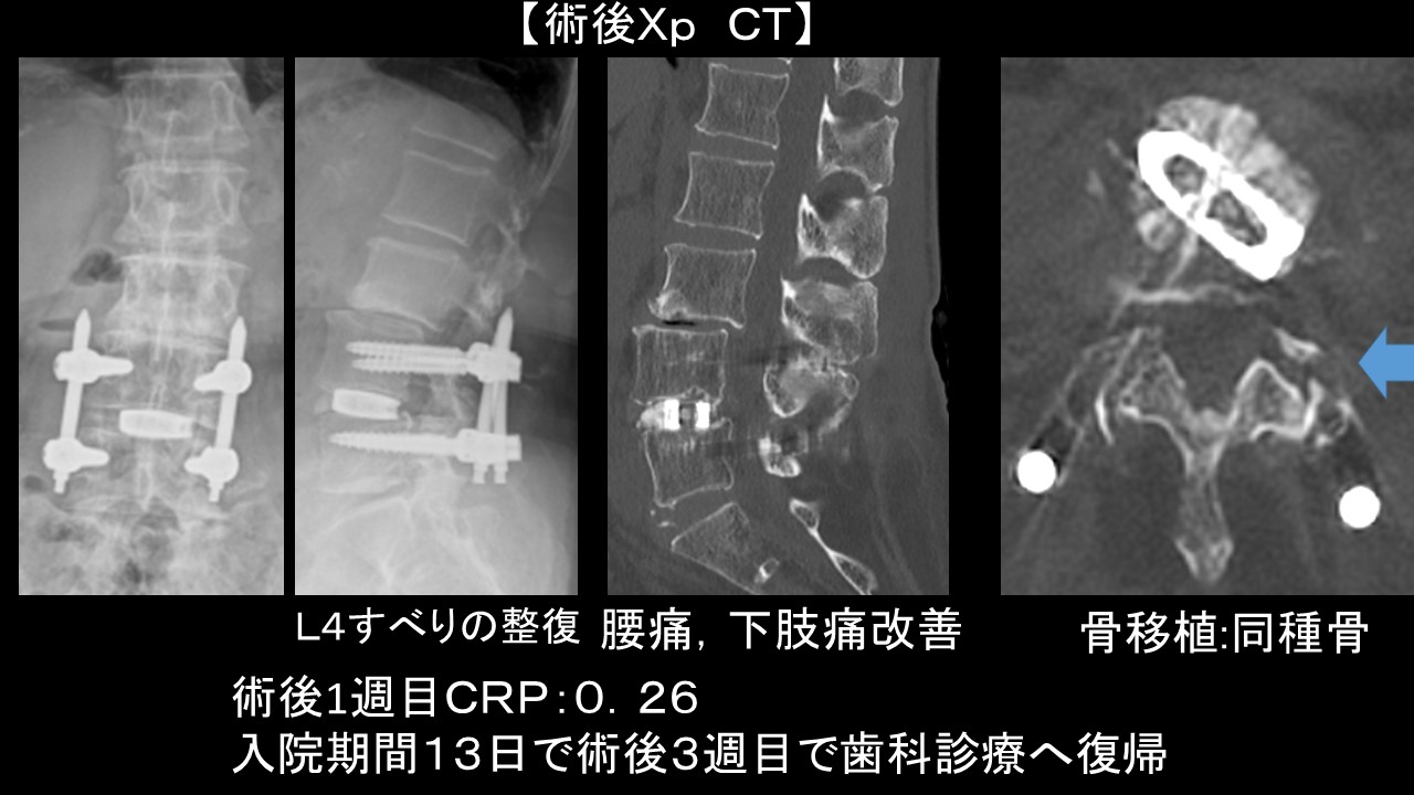 ＰＥＴＬＩＦ症例５.JPG