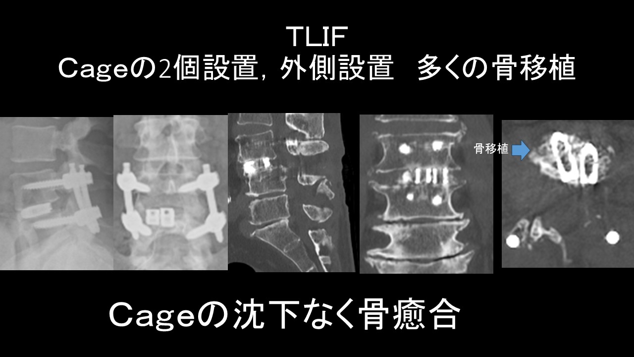 ＴＬＩＦ骨癒合良好.jpg