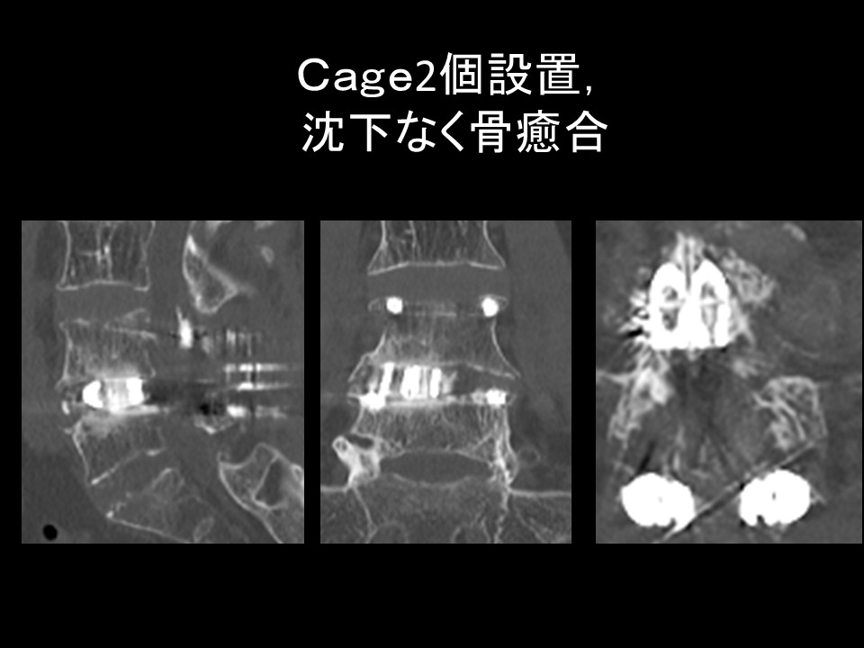 ＴＬＩＦＣａｇｅ2個骨癒合.jpg
