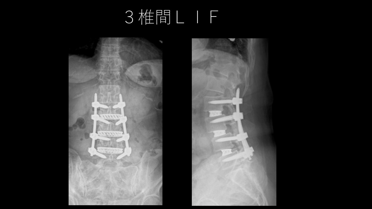 LLIFで神経障害を防ぐには？