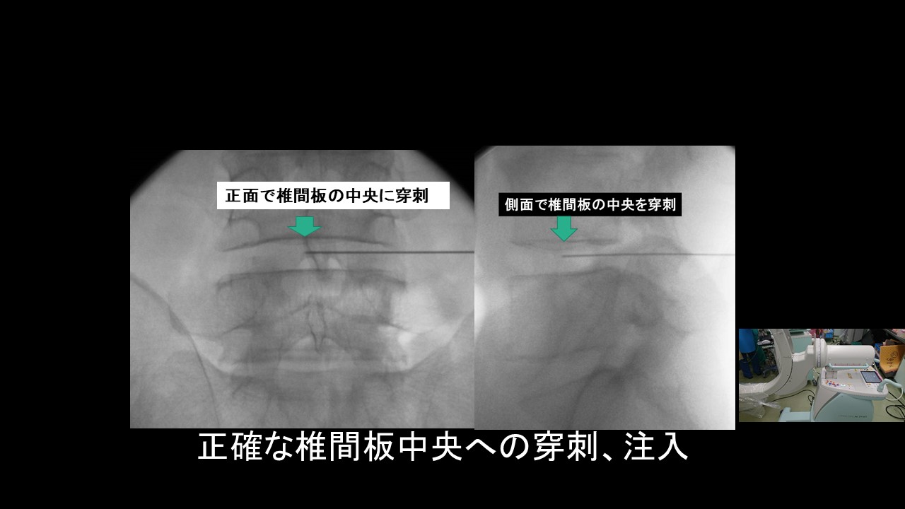 低侵襲で効果的！腰椎椎間板ヘルニア治療の新時代：椎間板内酵素注入