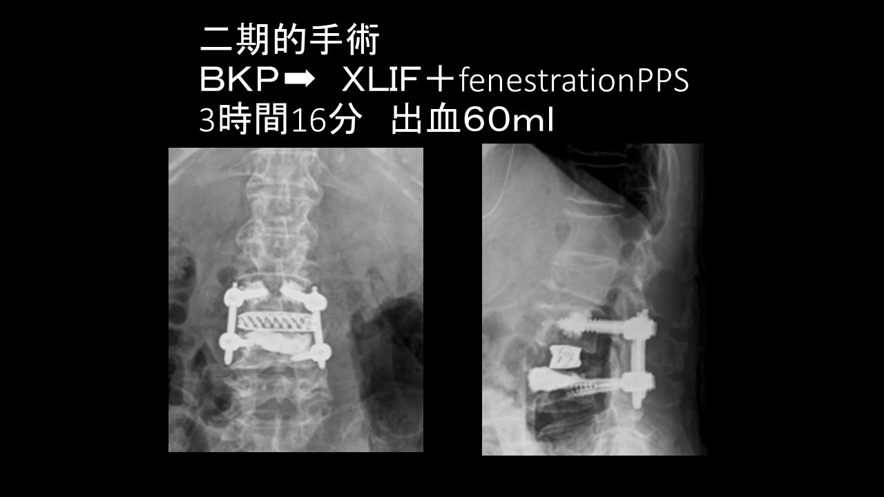 BKPとlif.JPG