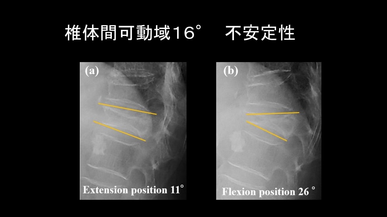 BKPrevision risk椎体不安定性.jpg