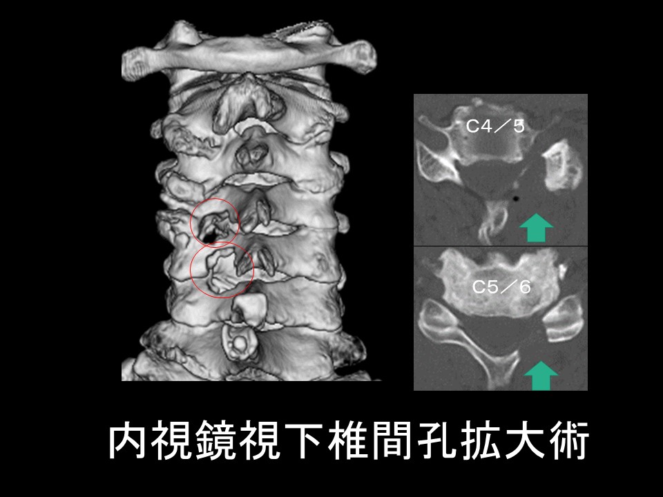 CSA術後ＣＴ.JPG