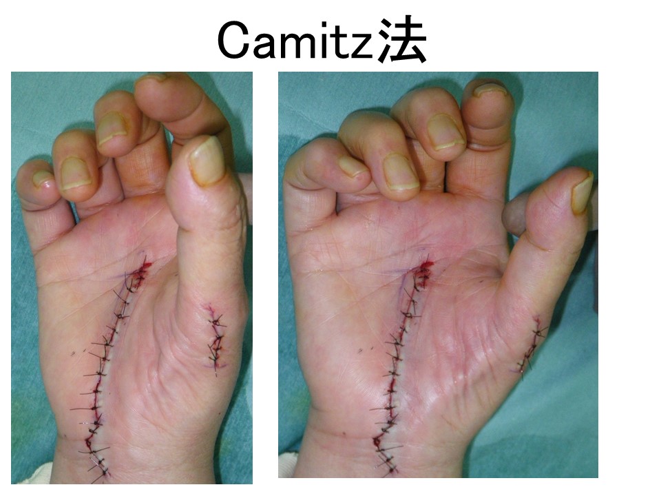 Camitz術後pg.jpg