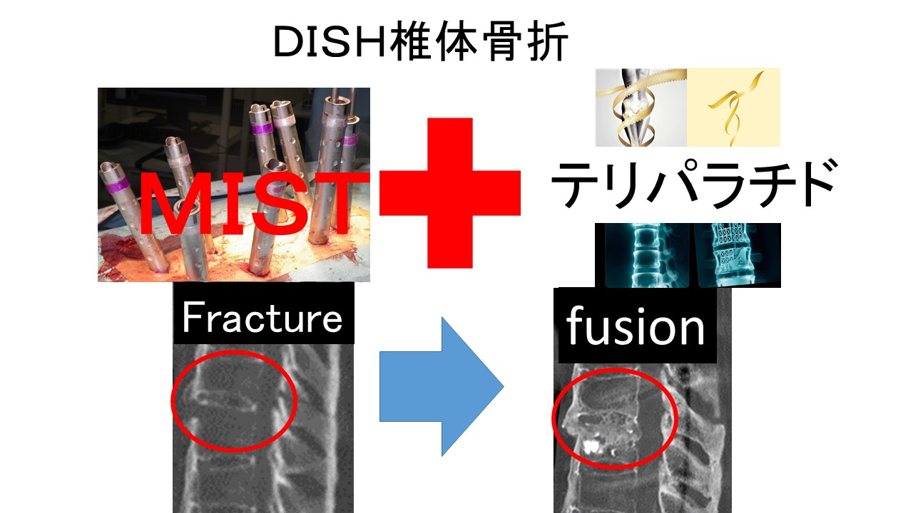 DSIHＭＩＳＴとテリパラチ.jpg