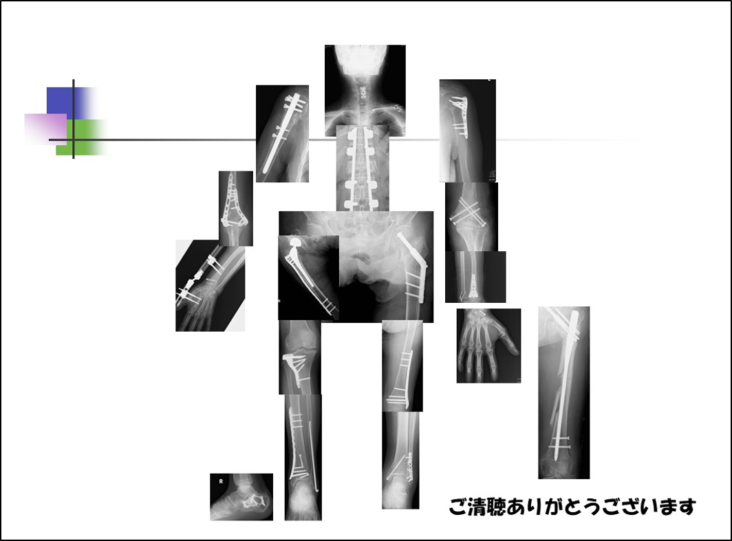 骨折治療の要点と盲点 骨折治療の要点と盲点