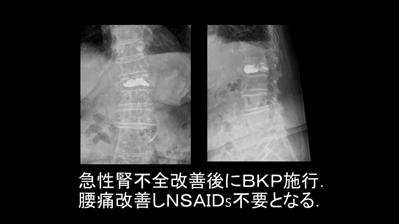 サプリメントだけではない痛み止めでも気を付けたい腎機能障害