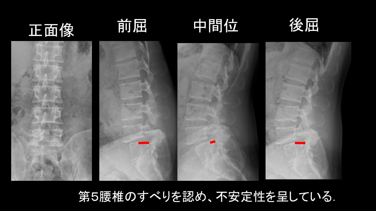 新 OS NEXUS No.13 脊椎の再建法―すべり症から脊柱変形まで