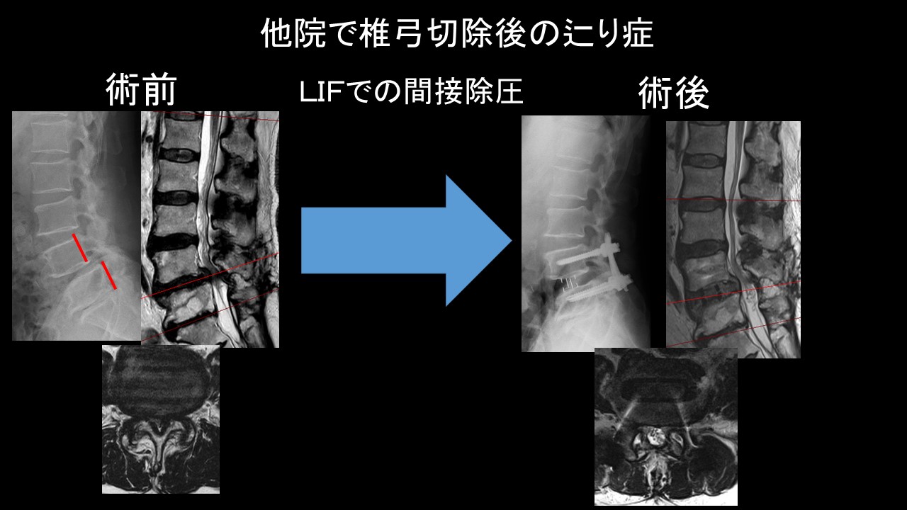 LIF間接除圧症例.JPG