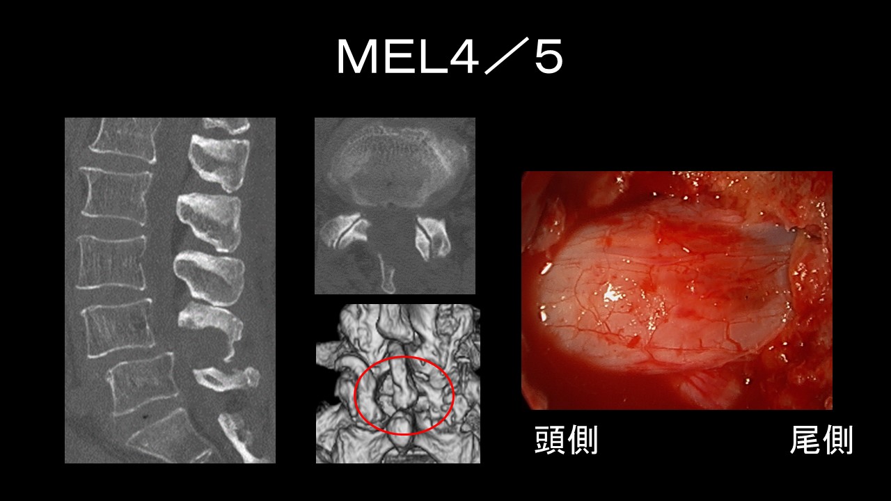 腰椎椎間板ヘルニアに対するMED手術:体への負担を減らす低侵襲 腰椎椎間板ヘルニアに対するMED手術:体への負担を減らす低侵襲
