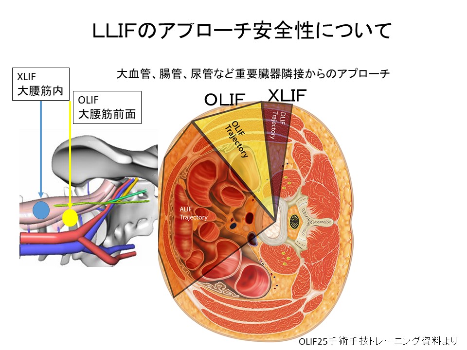 OLIFアプローチ.JPG