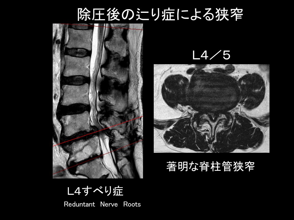 OLIF症例1.JPG