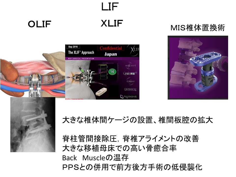 OVFに対するLLIFによる再建 熊整会用.jpg