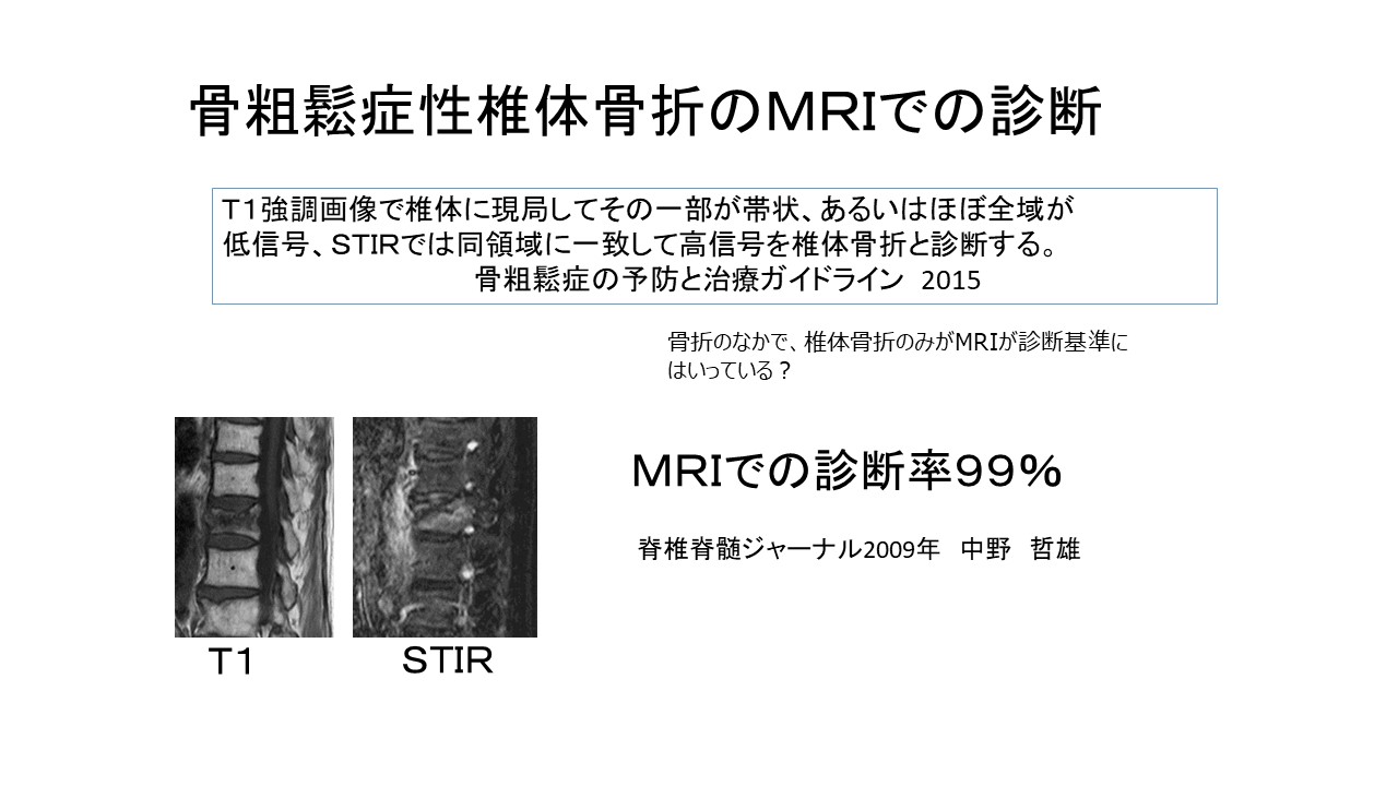 AIでの胸腰椎椎体骨折のX線診断精度 ｜ 成尾整形外科病院