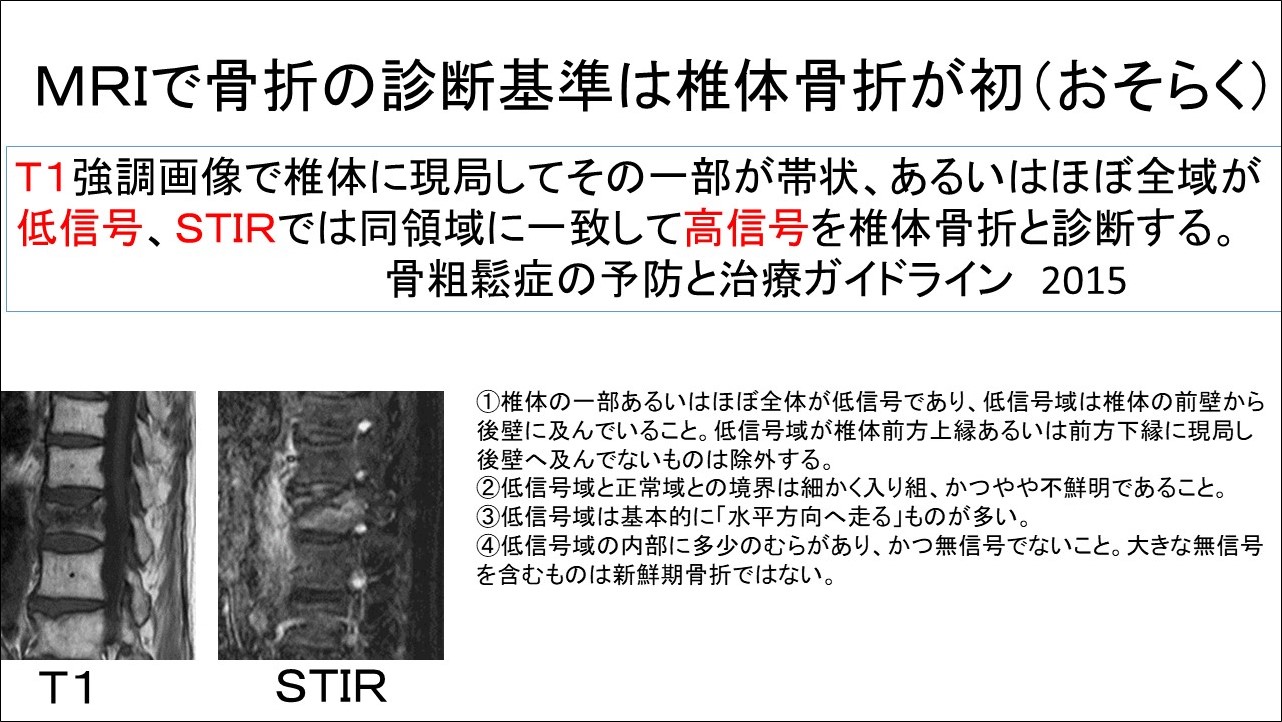 骨粗鬆症性椎体骨折（OVF:osteoporotic vertebral fracture