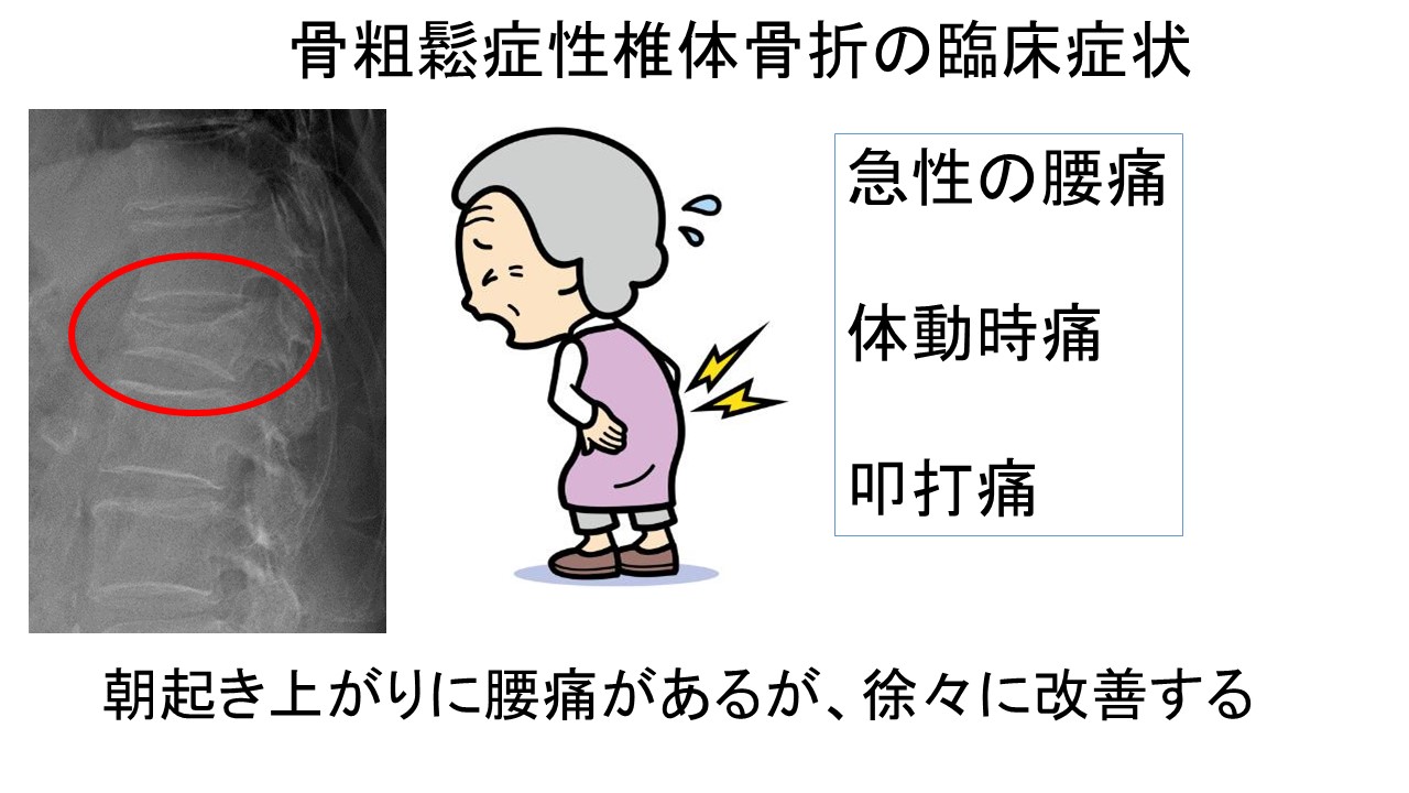 骨粗鬆症による椎体骨折の痛みを軽減する治療法：保存療法の効果を徹底