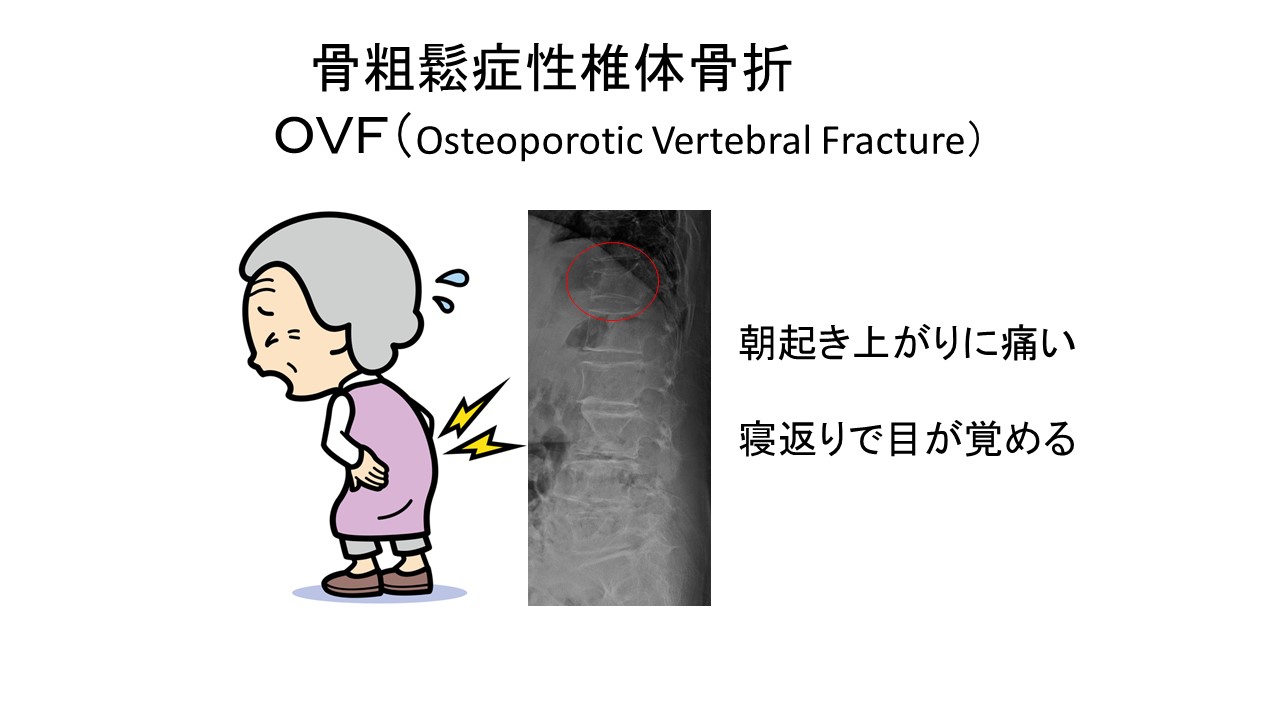 AIでの胸腰椎椎体骨折のX線診断精度 ｜ 成尾整形外科病院