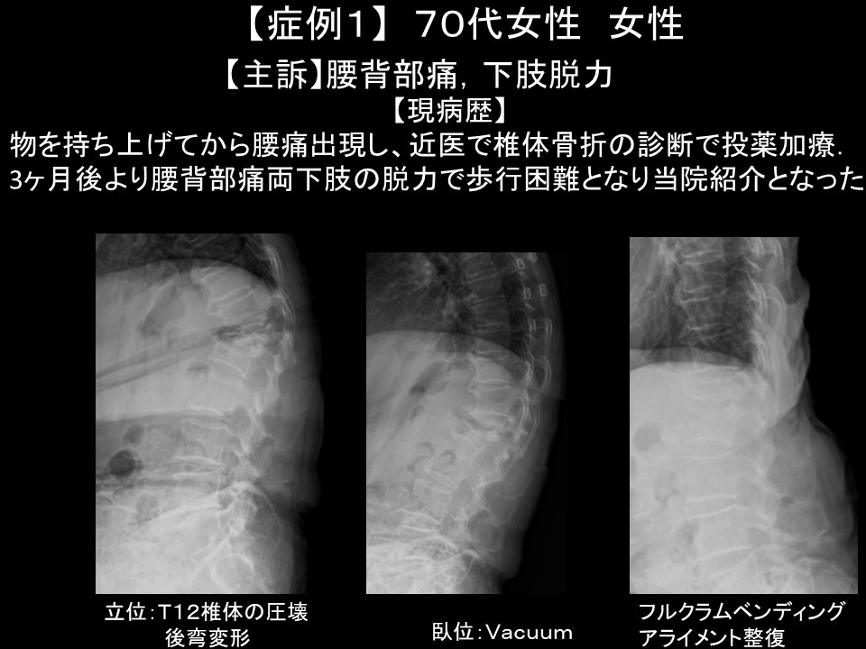 骨粗鬆症性椎体骨折に対する脊柱再建術 ｜ 成尾整形外科病院
