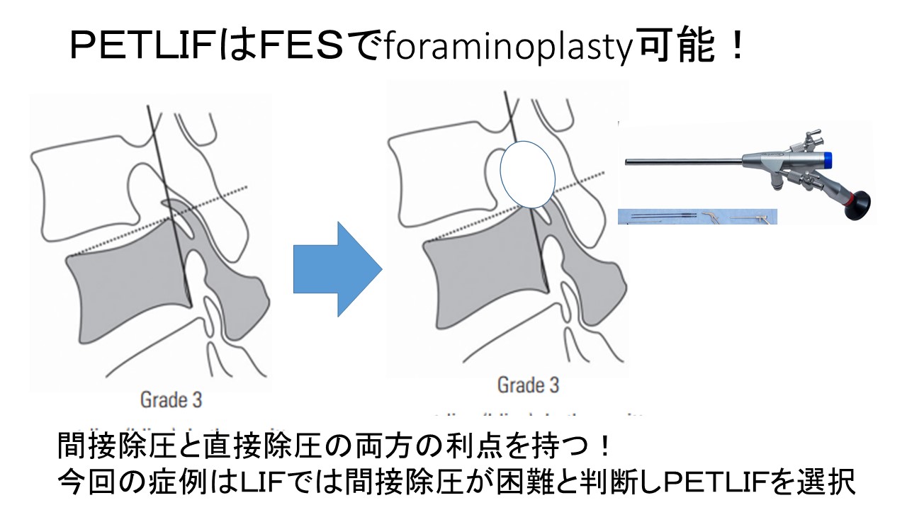 PETLIF間接除圧 (2).JPG