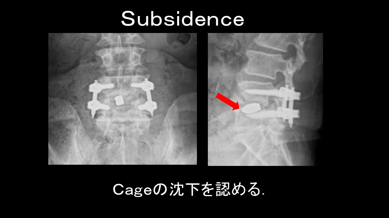 腰椎固定術の成功を左右する「ケージ沈下」とは？」リスクと対策を